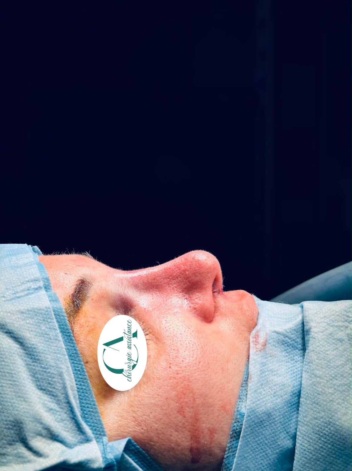 Résultat rhinoplastie - Avant/Après