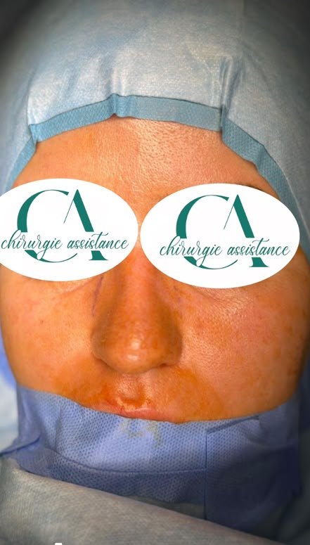 Avant rhinoplastie, vue de face