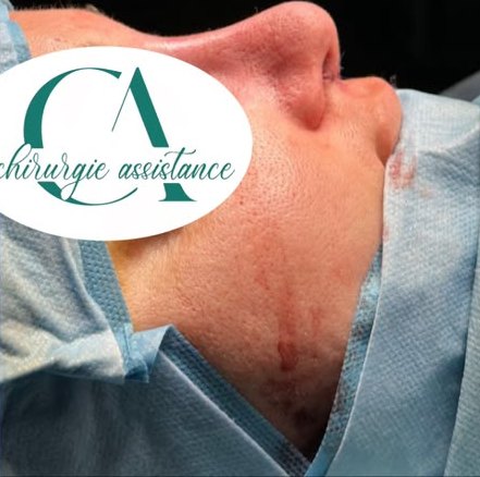 Après rhinoplastie, vue de profil